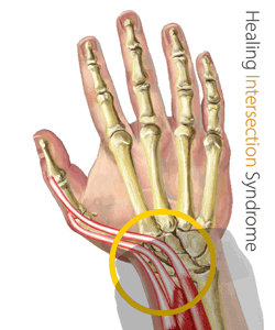 An animation of an Intersection Syndrome injury being treated by a King Brand® BFST® Wrist Wrap